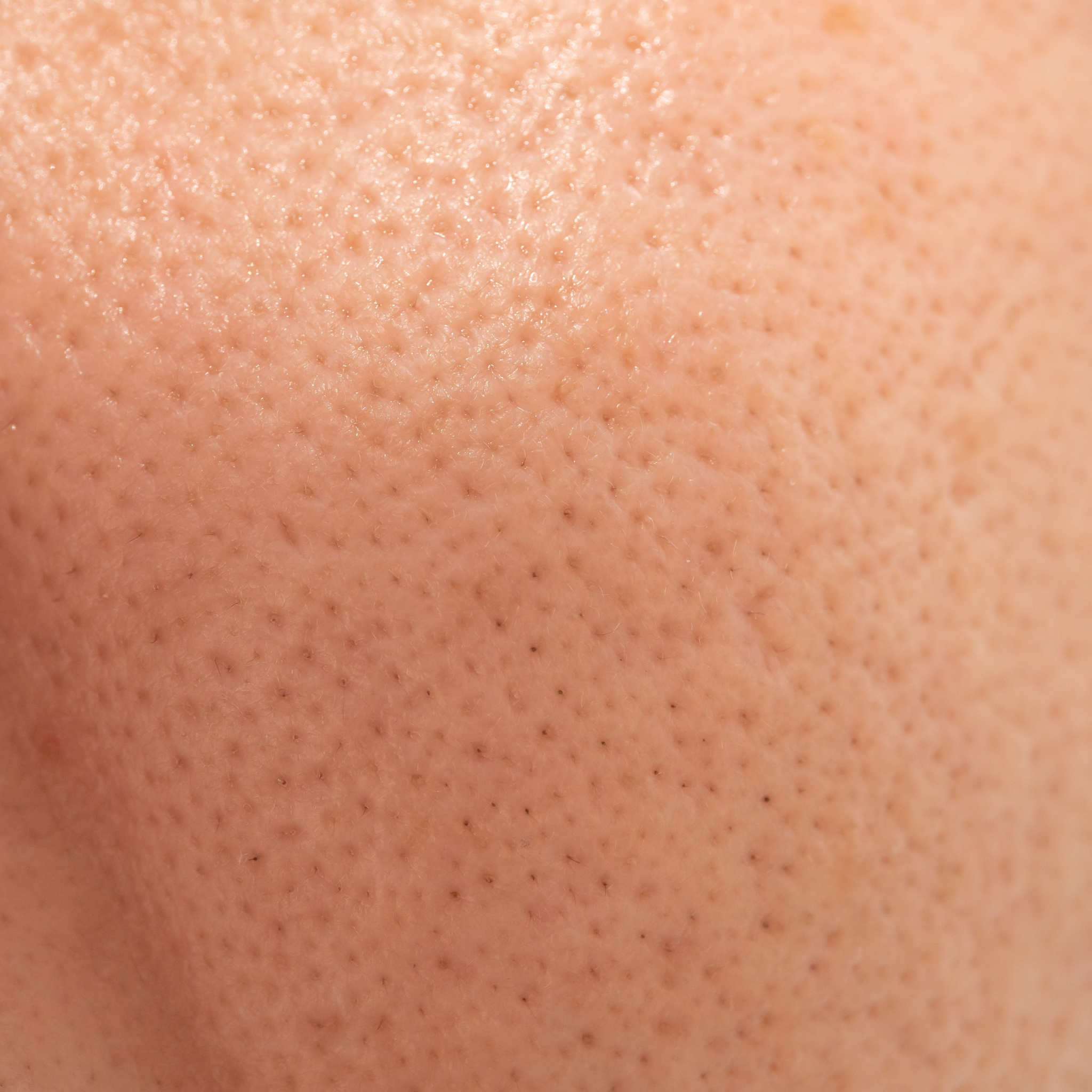 pores_blackheads